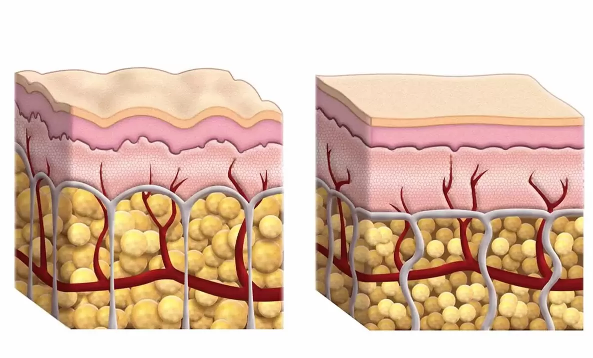 Adipocytes during use of Keto Guru