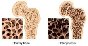 Osteoporosis of the bone